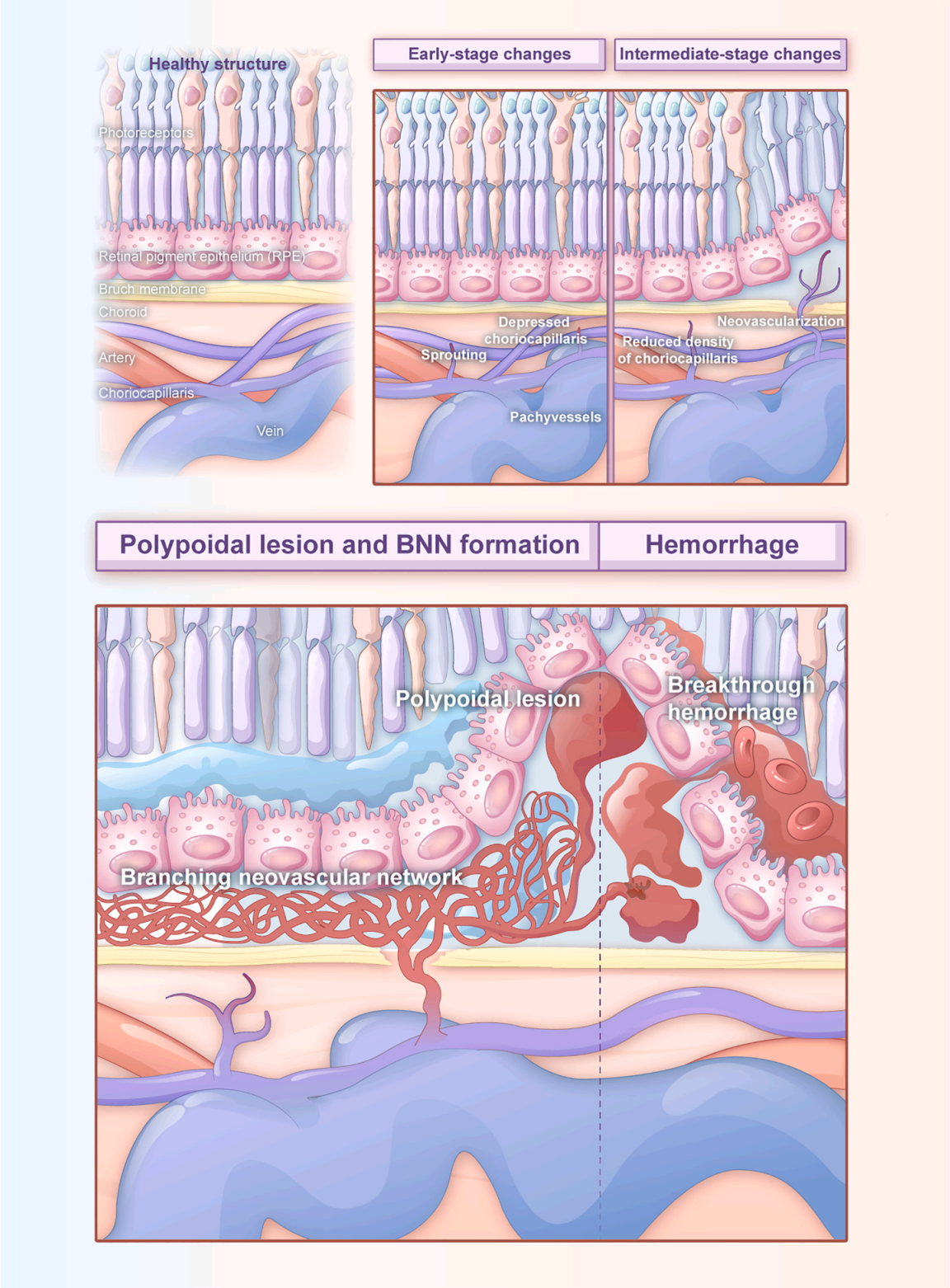临床研究成果|北京协和医院陈有信教授团队全面解析息肉状脉络膜血管病变 临床研究成果|北京协和医院陈有信教授团队全面解析息肉状脉络膜血管病变