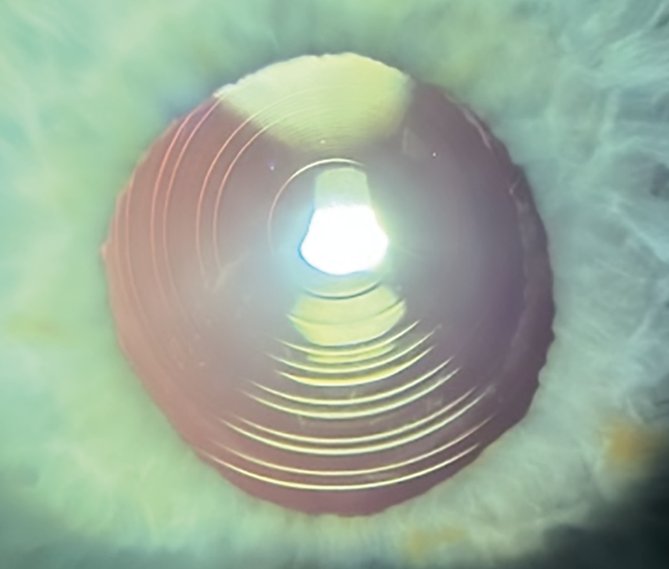 人工晶状体光学设计新时代的探索 人工晶状体光学设计新时代的探索