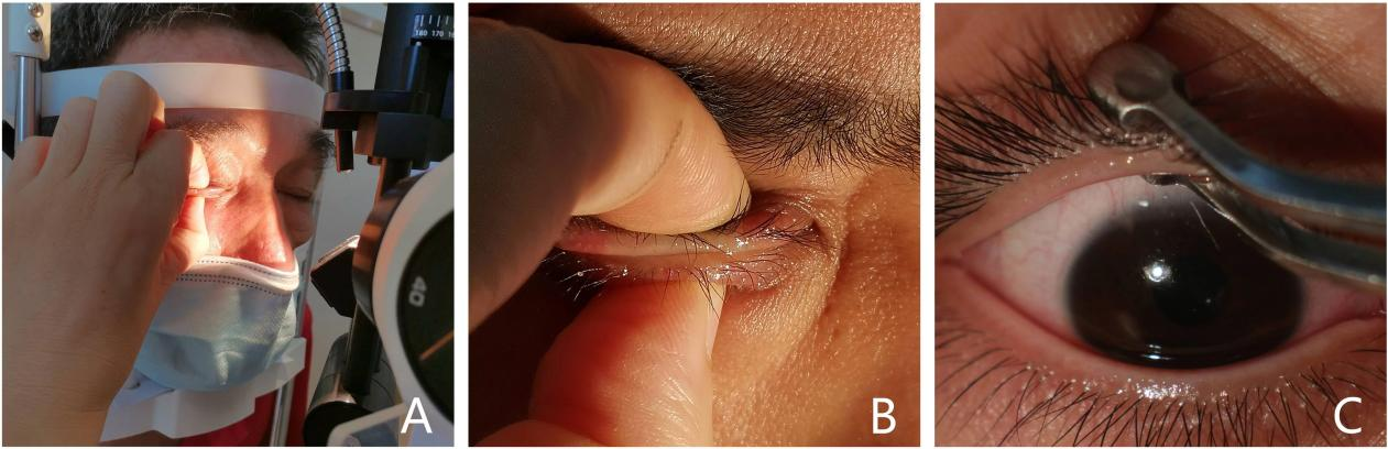 徒手与器械辅助睑板腺按摩治疗睑板腺功能障碍的疗效与可行性比较