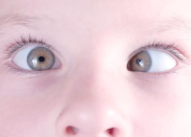 麻痹性斜视与限制性斜视的临床鉴别要点与诊疗策略 麻痹性斜视与限制性斜视的临床鉴别要点与诊疗策略