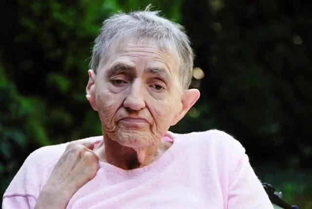 屈光异常与阿尔茨海默病:视网膜神经纤维层厚度的“预警价值” 屈光异常与阿尔茨海默病:视网膜神经纤维层厚度的“预警价值”