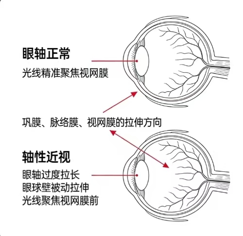 屈光异常与阿尔茨海默病:视网膜神经纤维层厚度的“预警价值” 屈光异常与阿尔茨海默病:视网膜神经纤维层厚度的“预警价值”
