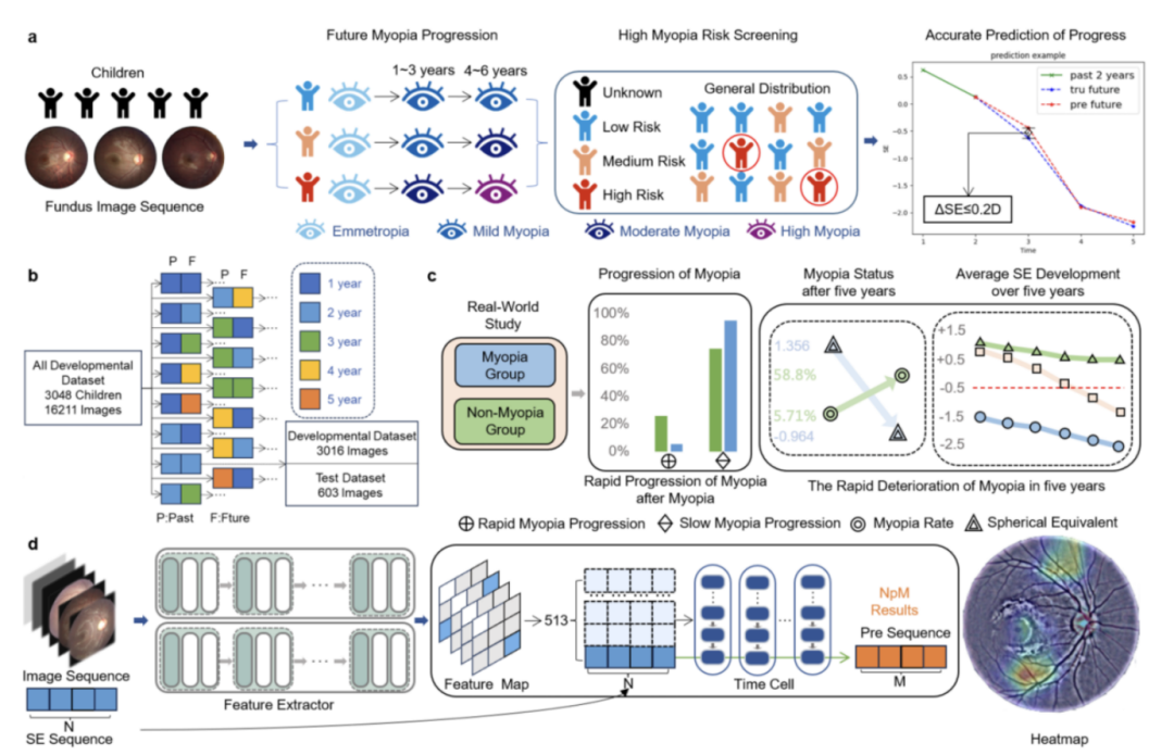 JAMA子刊儿童近视预测新突破